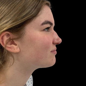 preservation-rhinoplasty-before